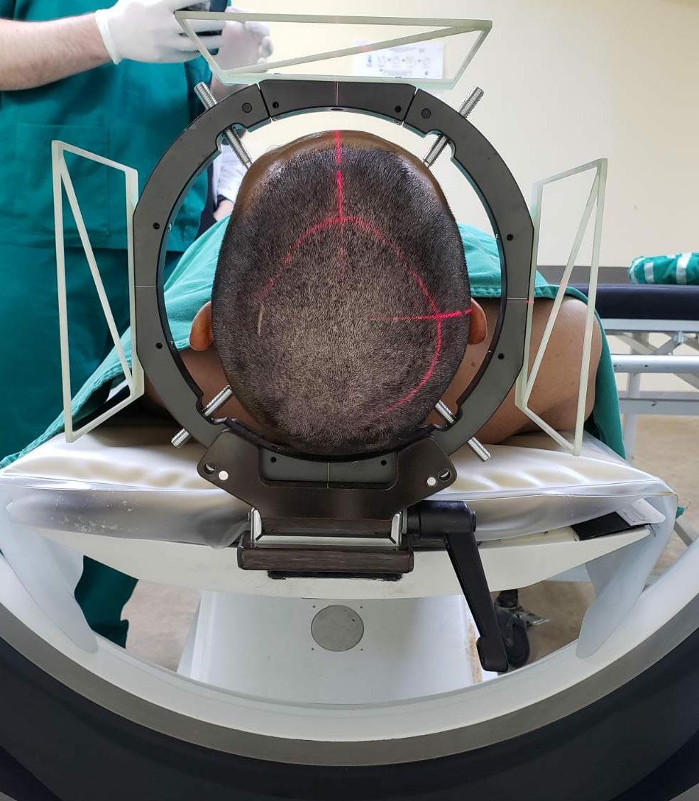 Neurocirugía estereotáxica: Hospital de Clínicas implementa innovadora técnica