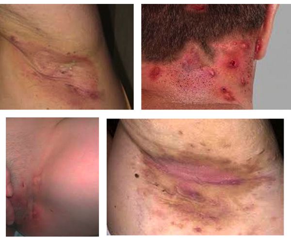 El estigma y la vergüenza retrasan el diagnóstico de la hidradenitis supurativa