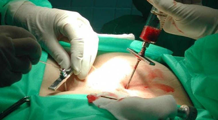 Hay 6 pedidos de trasplante de médula ósea, todos aprobados por Salud: falta la respuesta de IPS