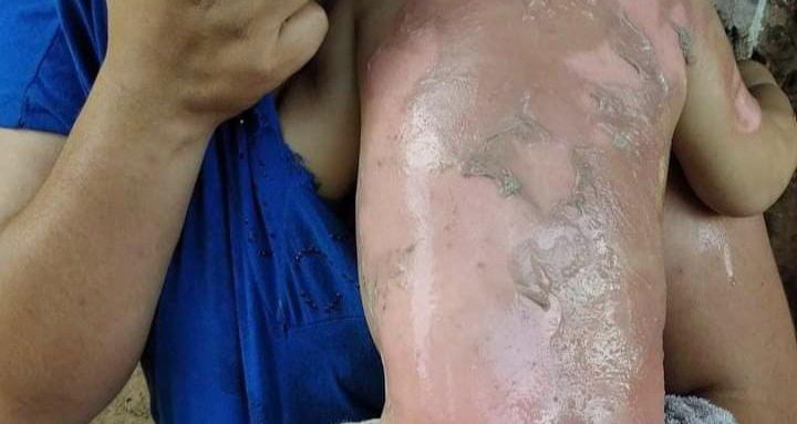 Bebé de 11 meses sufrió quemaduras y apelan a la solidaridad para seguir con su tratamiento