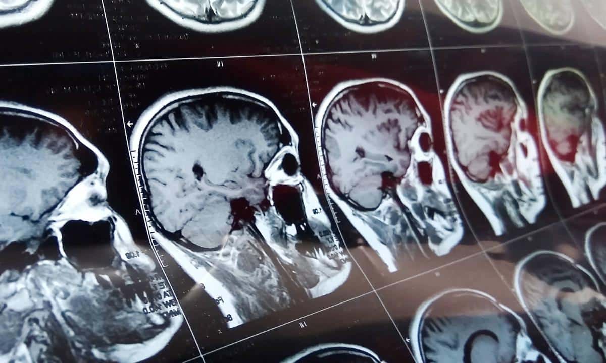 Con IA, buscan anticipar pronóstico de tumor cerebral en Hong Kong