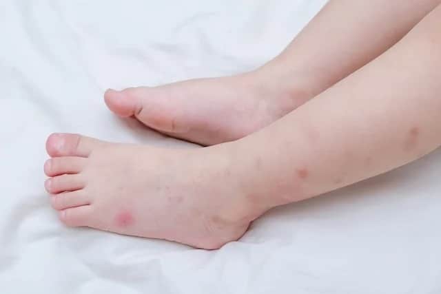 ¡Cuidado con el dengue! De 19 fallecidos, alrededor de 8 son niños, reportan desde Salud